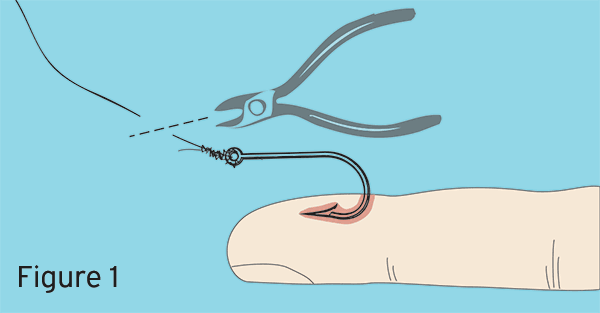 Embedded Fish Hook Removal