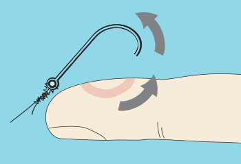 How to remove a fish hook from your skin 